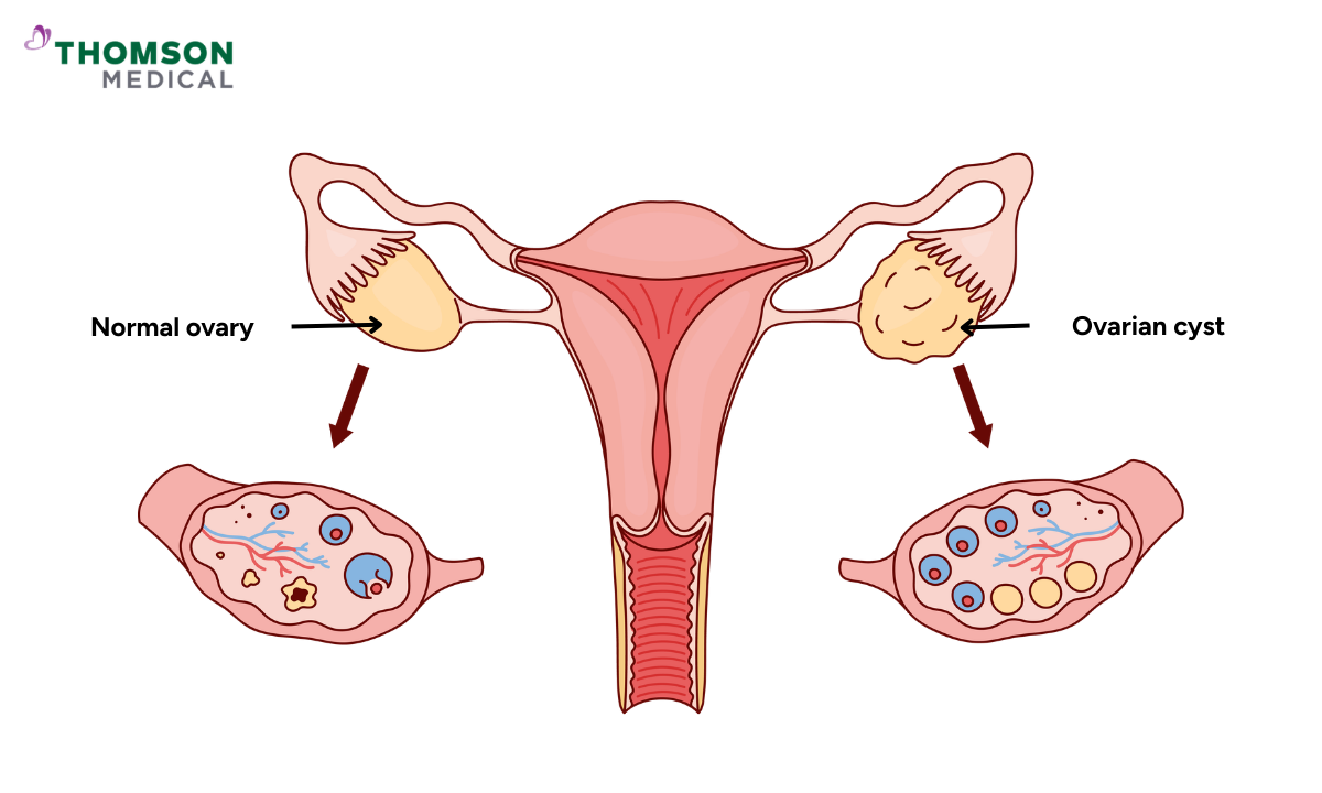 Illustration of a normal ovary and ovarian cyst
