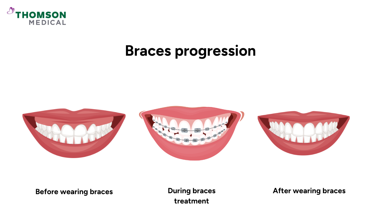Illustration of the braces progression