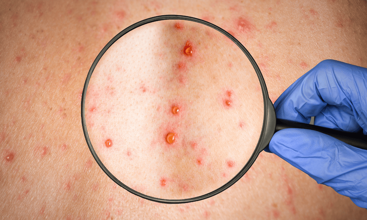 A close-up view of a skin rash consisting of small red spots and fluid-filled blisters, seen through a magnifying glass held by a person wearing a blue glove.