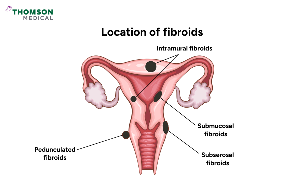 Illustration of location of fibroids