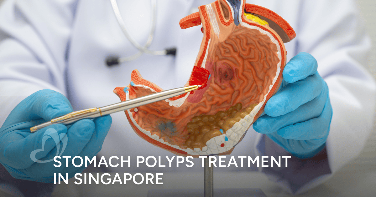 Stomach Polyps Treatment in Singapore: What to Expect | Thomson Medical