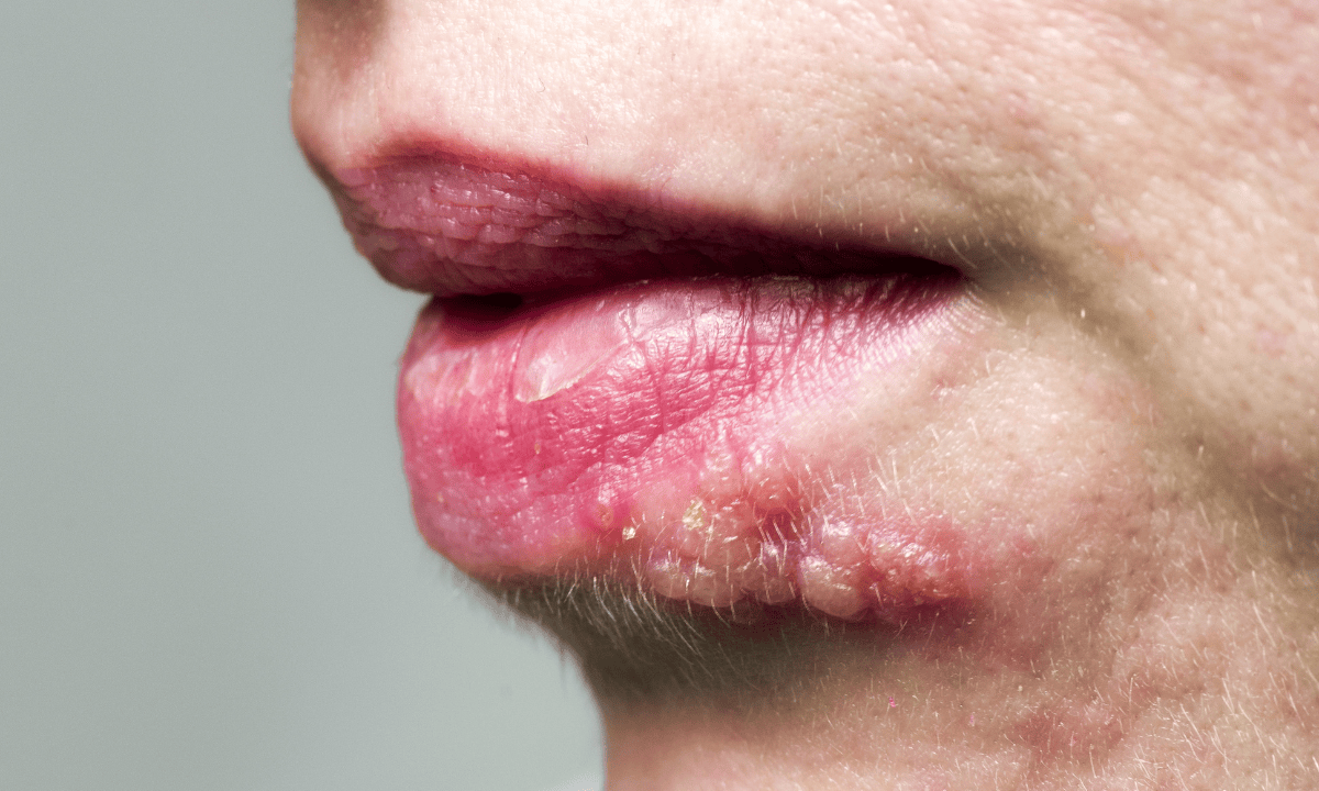 image of cold sores near-lips