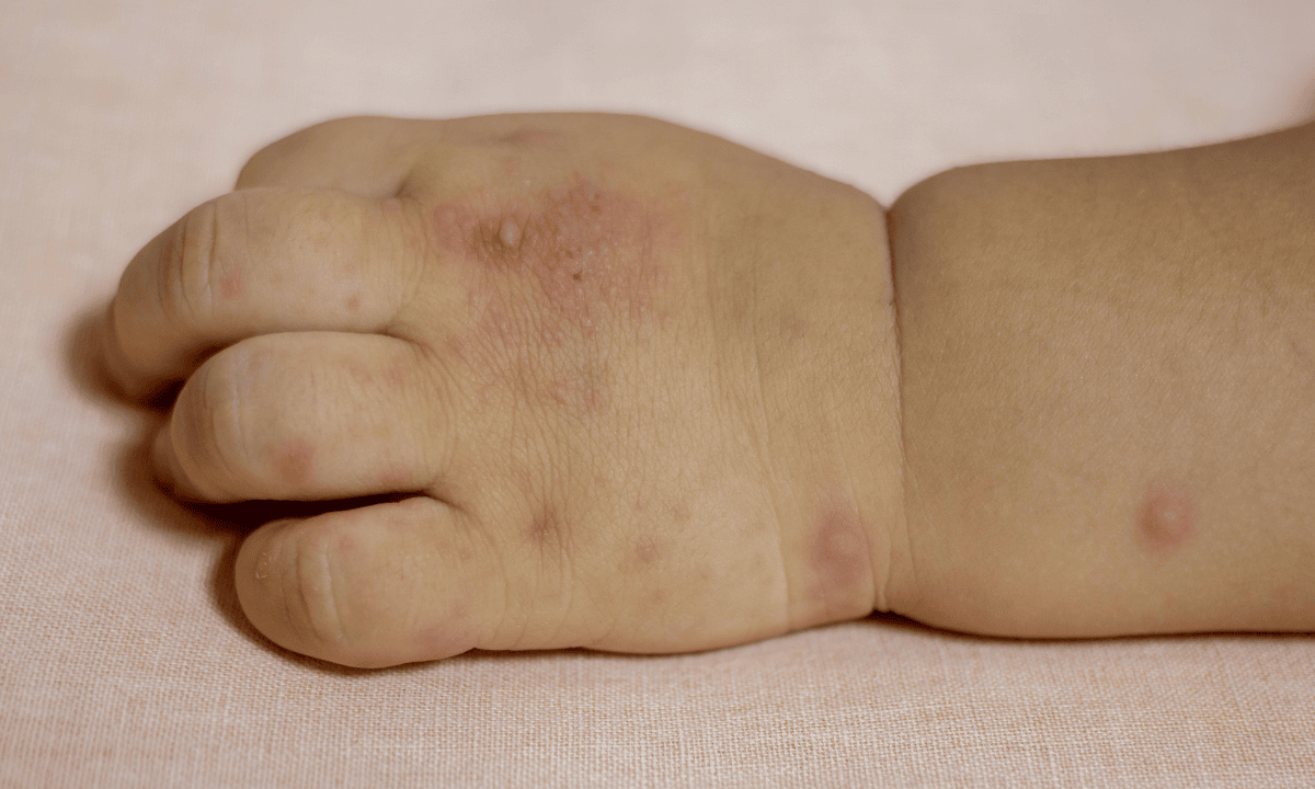 image of hfmd rashes on baby's hand