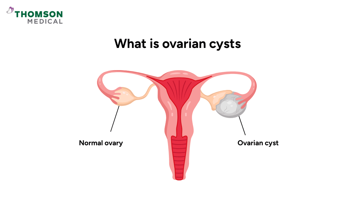 what is ovarian cysts