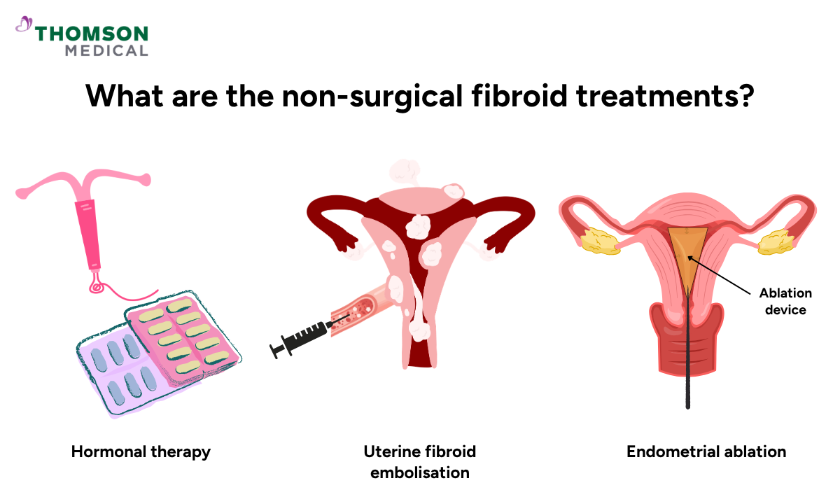 Illustration of the non-surgical fibroid treatments