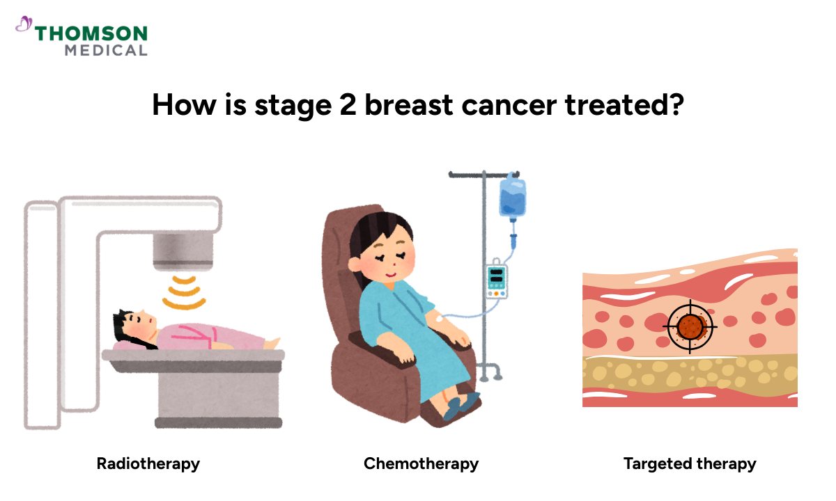 Illustration of how stage 2 breast cancer is treated