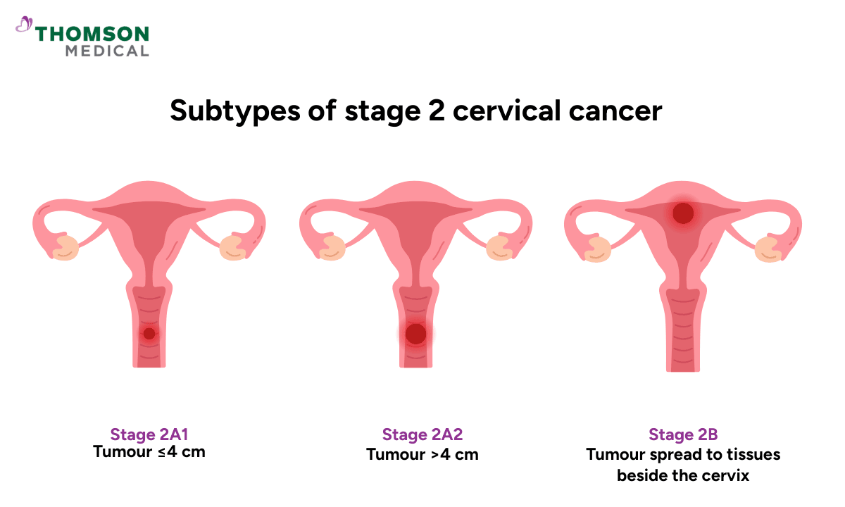 Substages of 2 cervical cancer