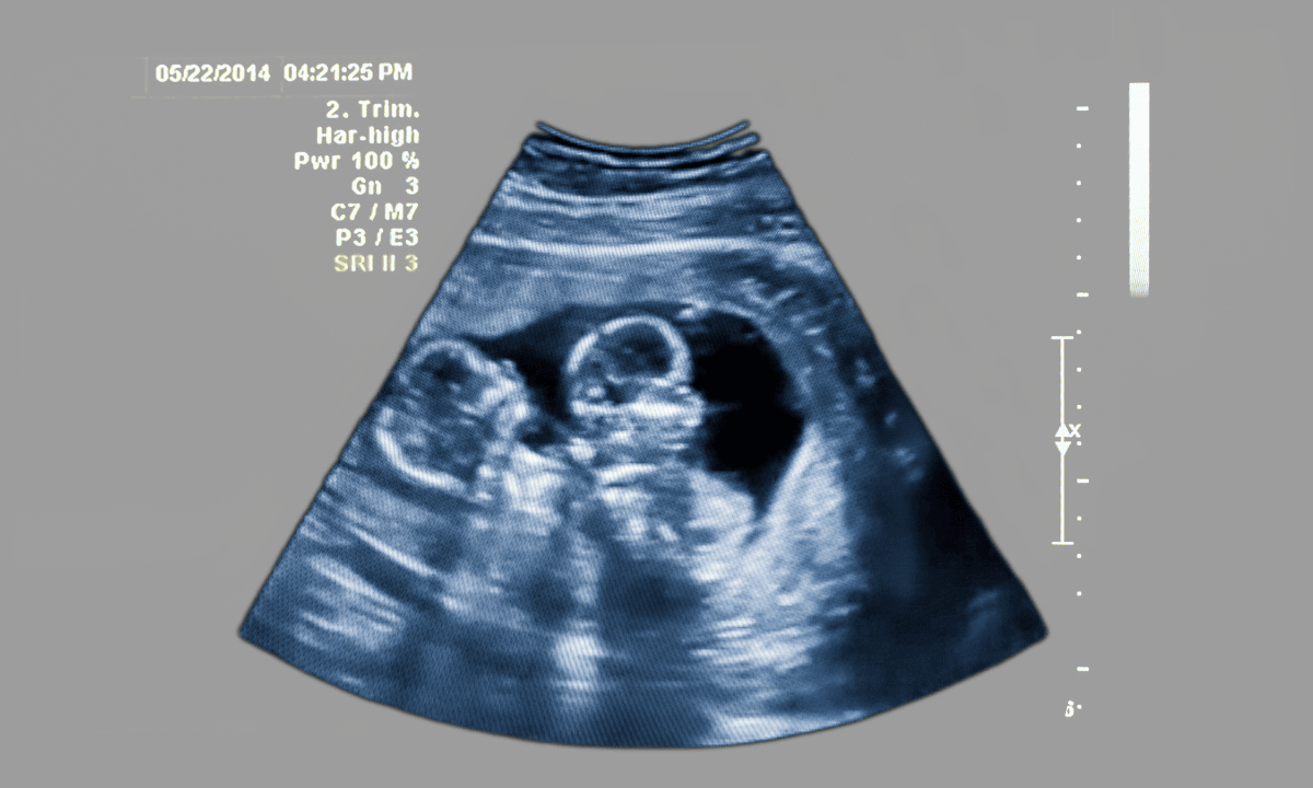 obgyn twins ultrasound