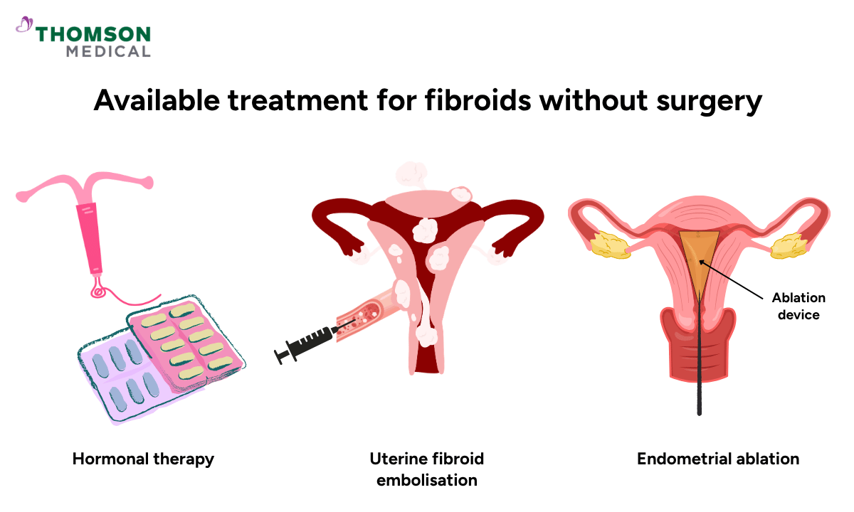 illustration of available treatment for fibroids without surgery