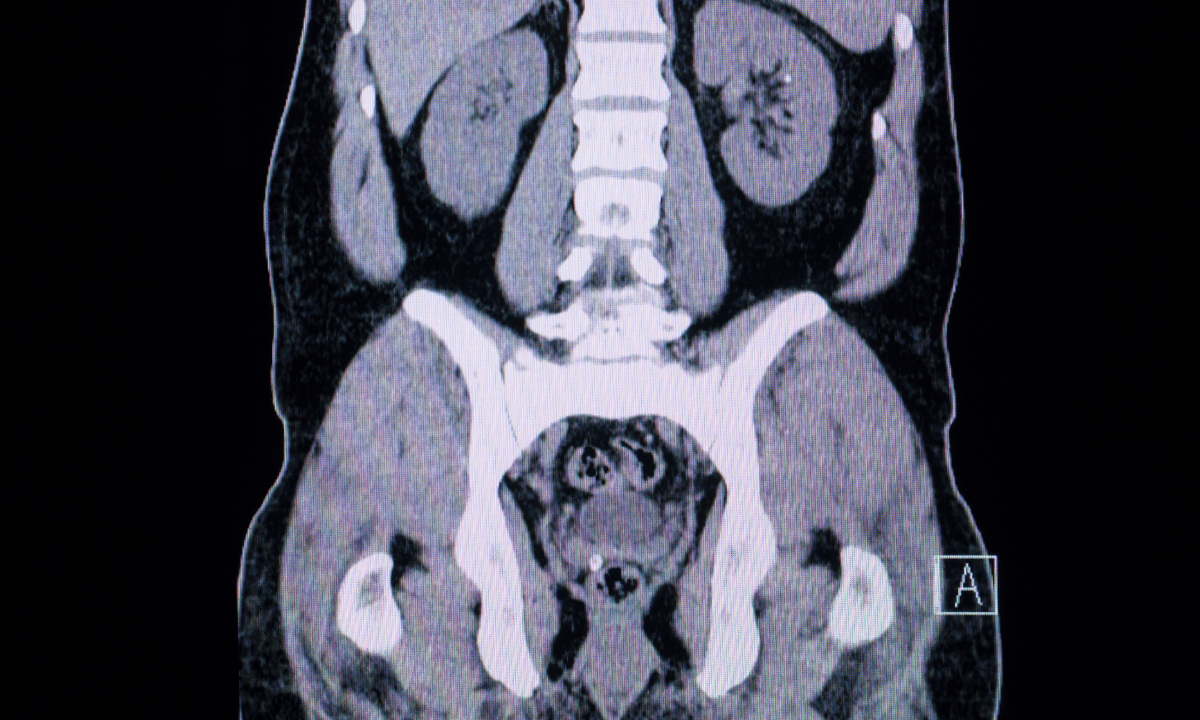 blog-image_obgyn_ct-scan-image.png