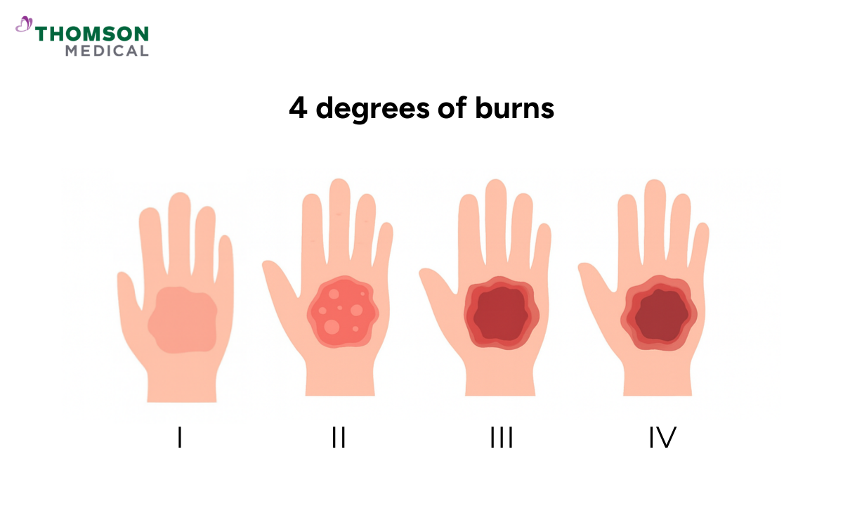 blog-image_ucc_degrees-of-burns.png