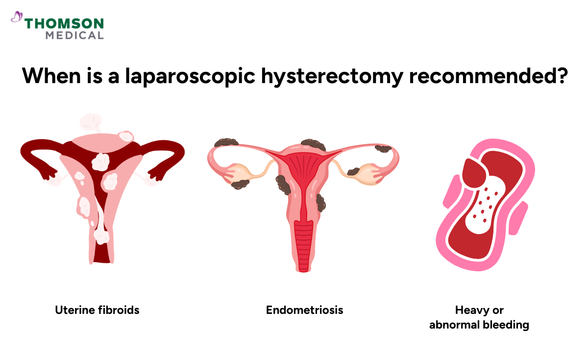 Illustration of when a laparoscopic hysterectomy is recommended