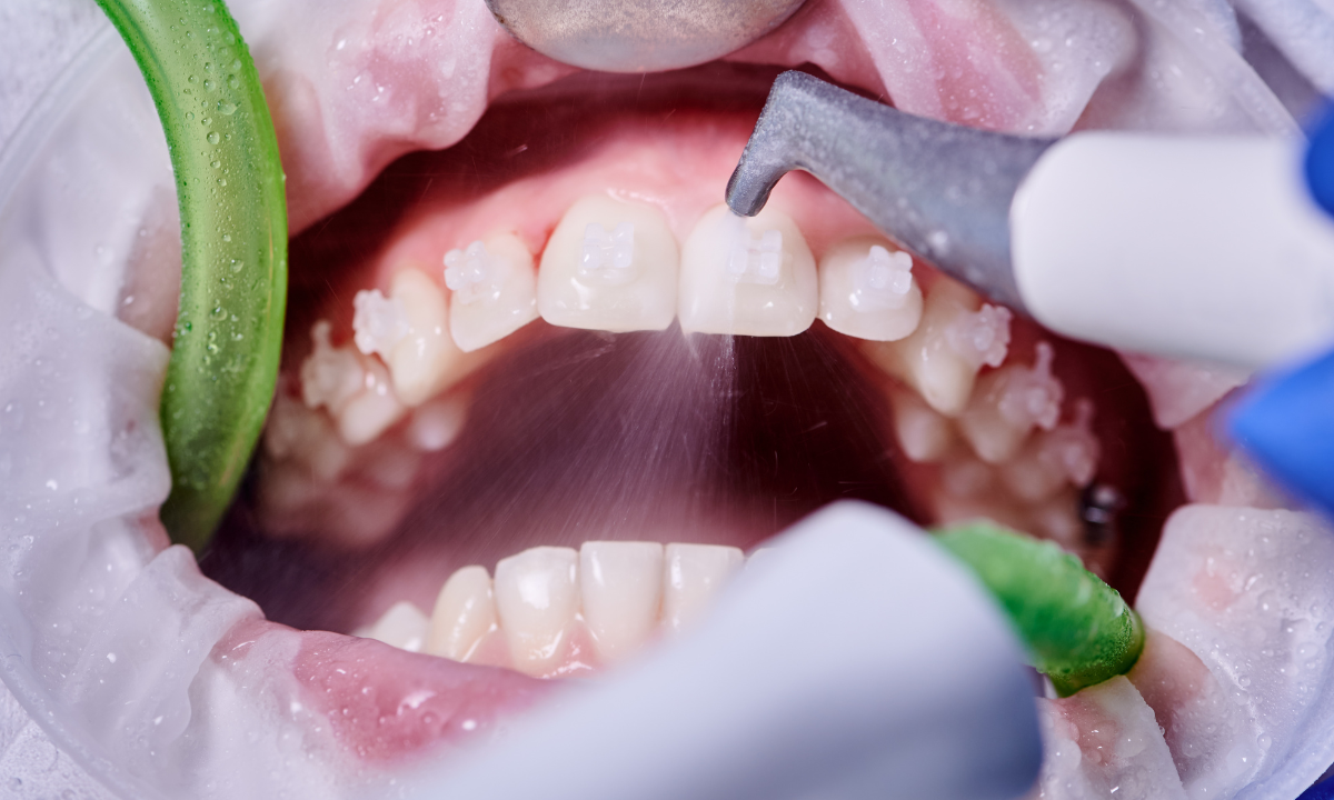 Extreme close-up of a patient's mouth during a dental procedure