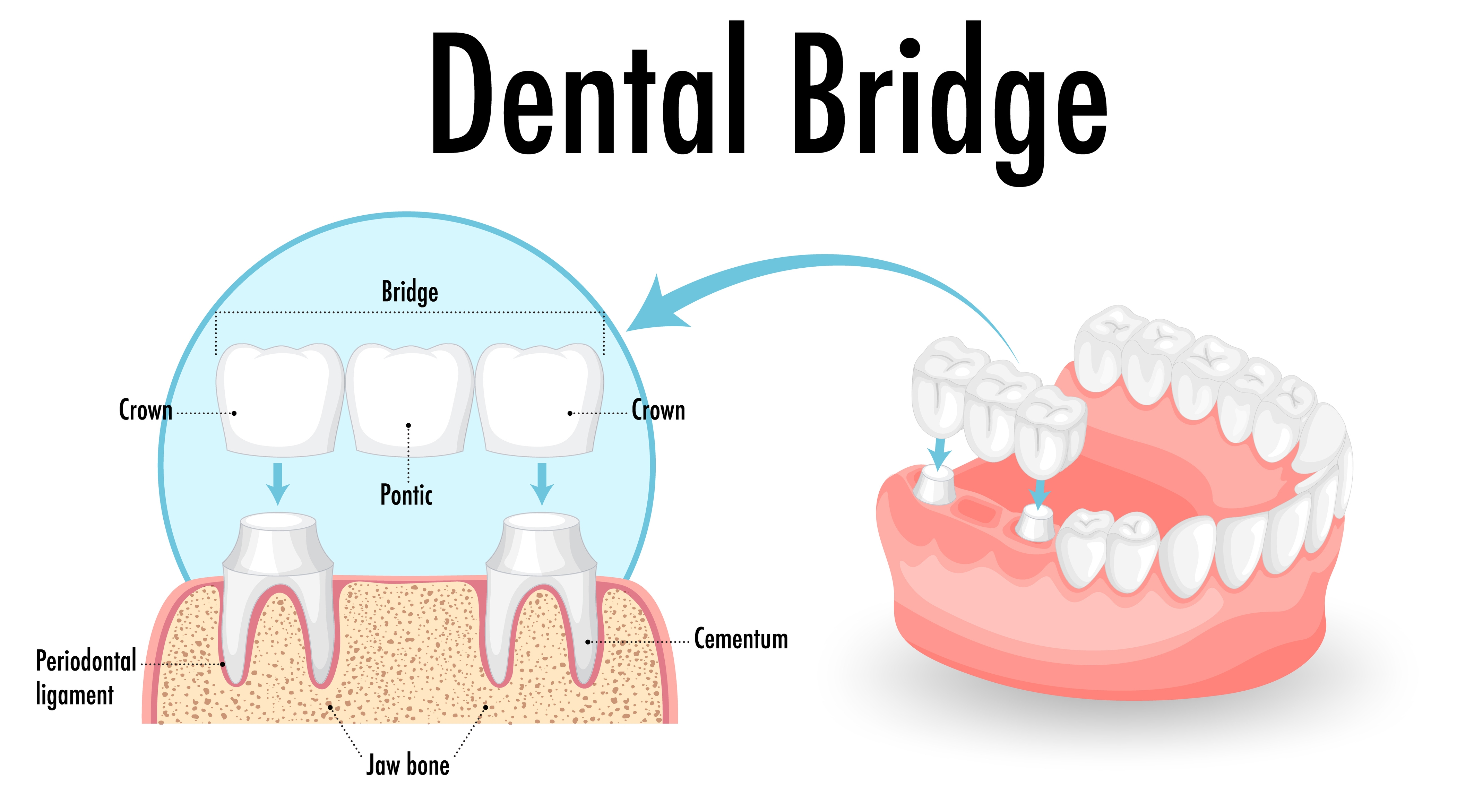 Dental-bridge.jpg