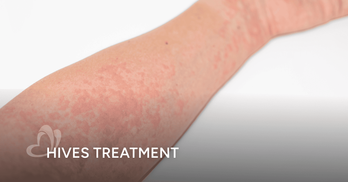 How to Treat Hives?