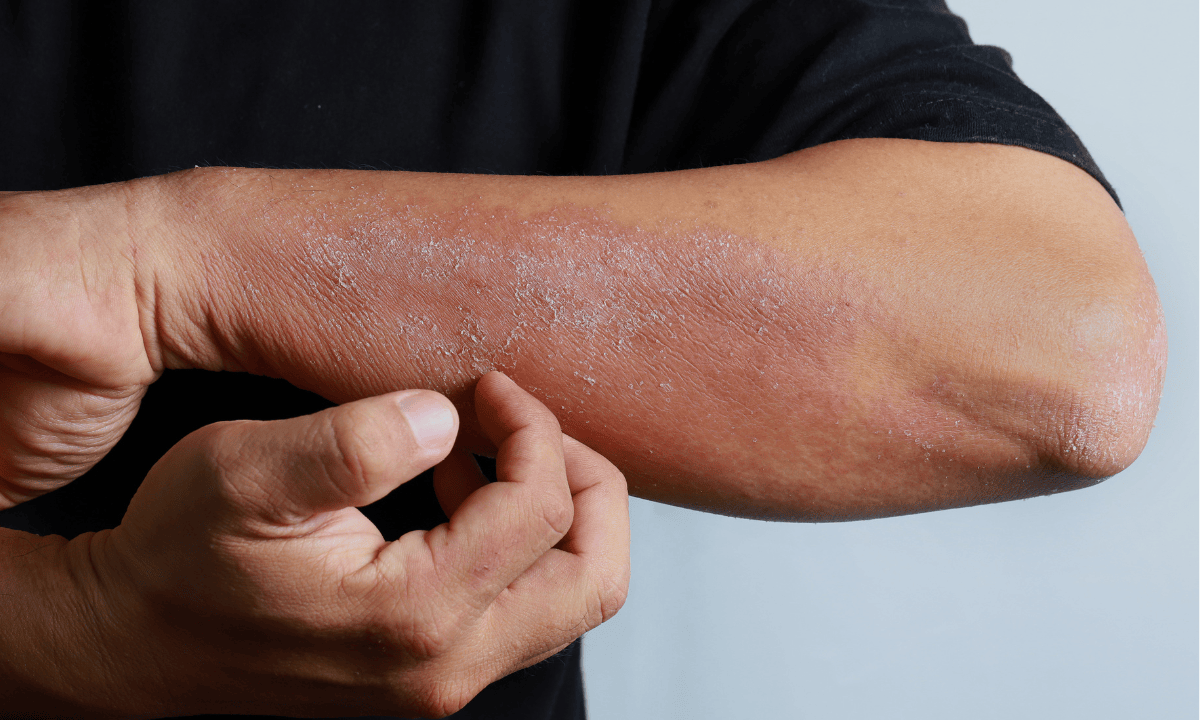 man itch from having eczema flare-up