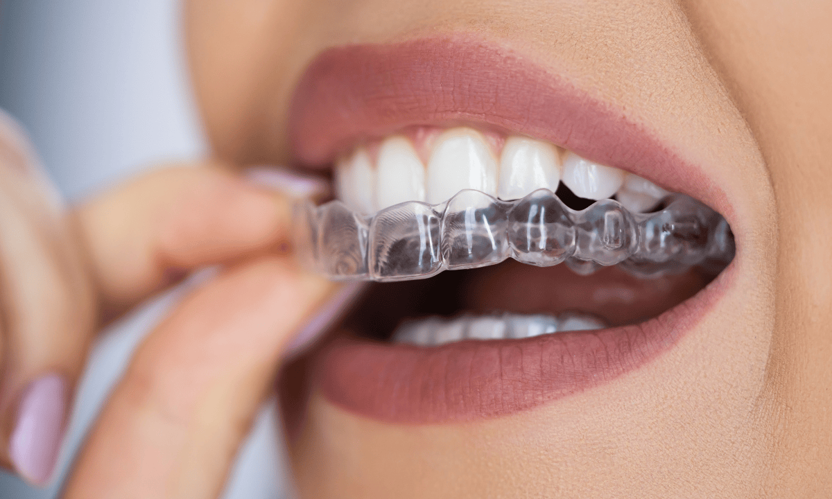 blog-image_dental_teeth-straightening-clear-aligners.png