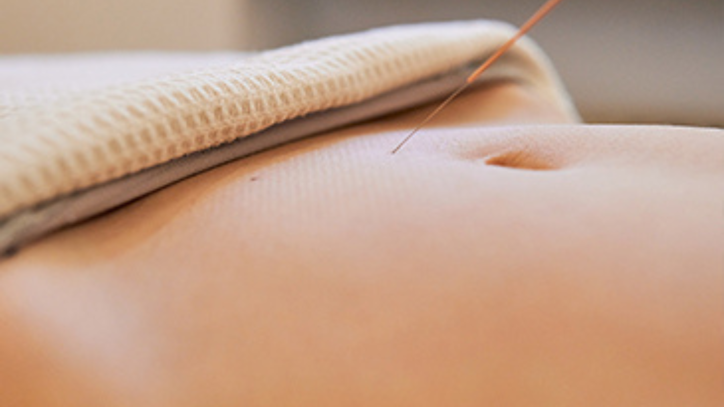 Fertility Acupuncture: Can It Help Your Chances Of Conceiving? | Thomson Medical