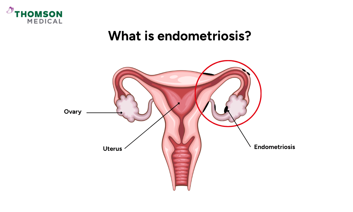 illustration of endometriosis location
