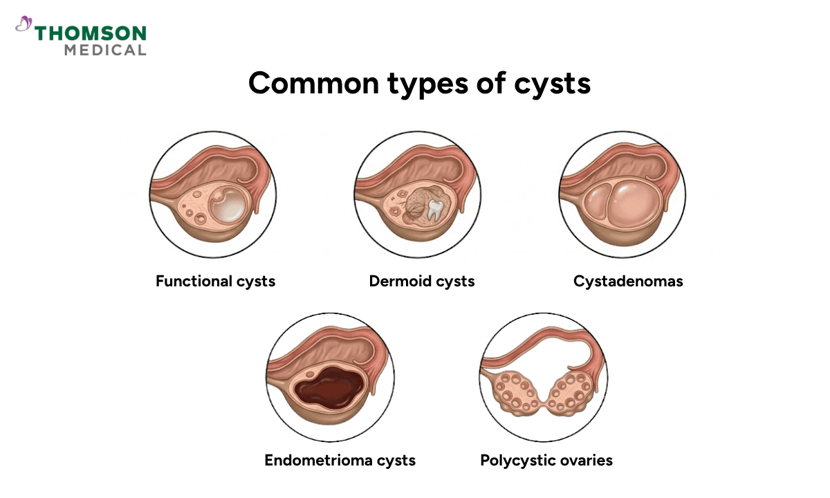 common types of ovarian cysts