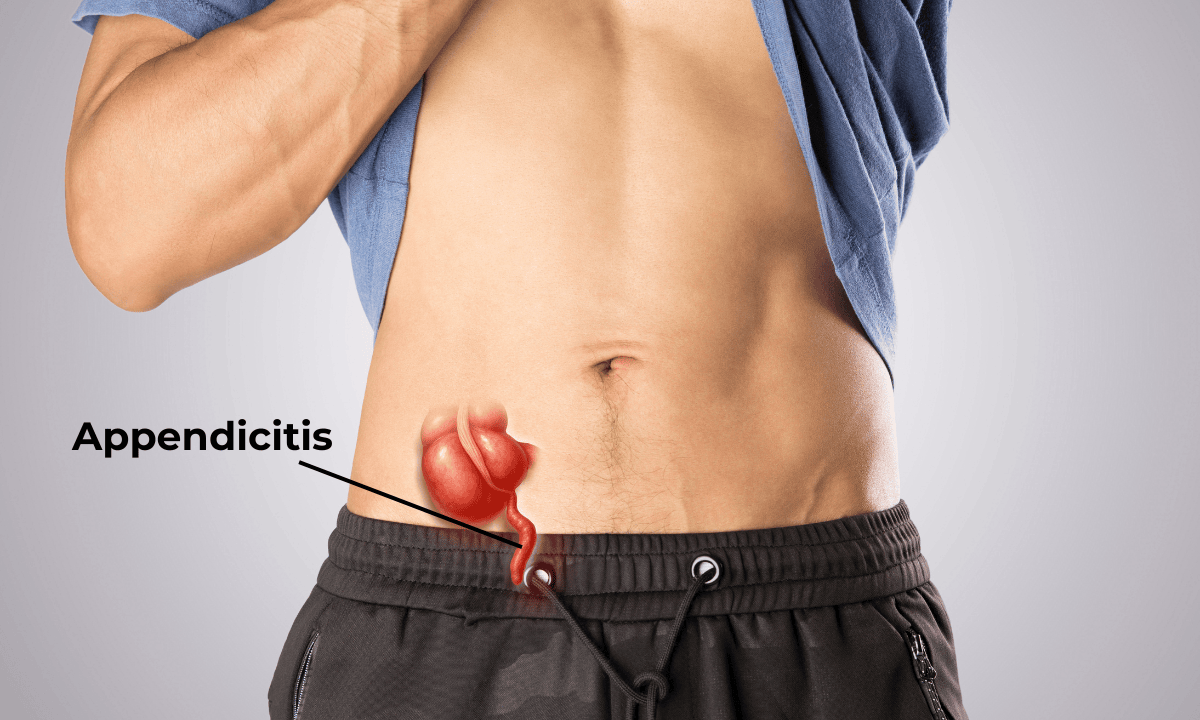 Image-of-appendicitis-position