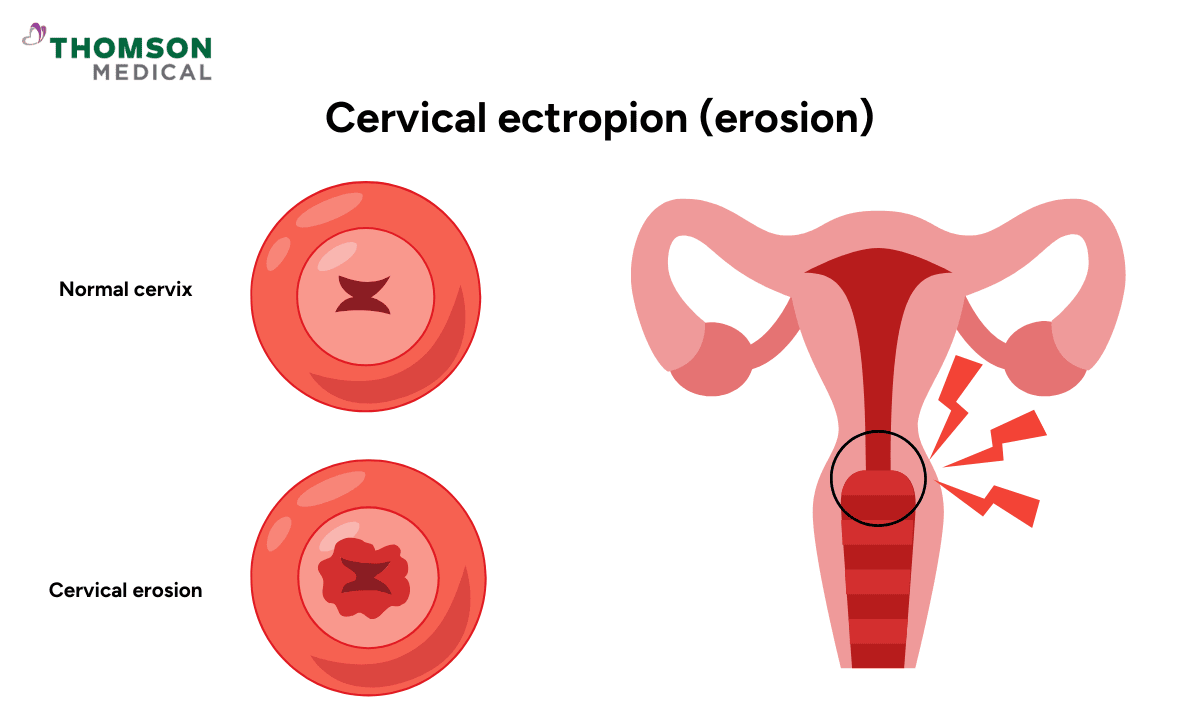 Normal cervix versus eroded cervix. Cervical ectropion. Cervical erosion.