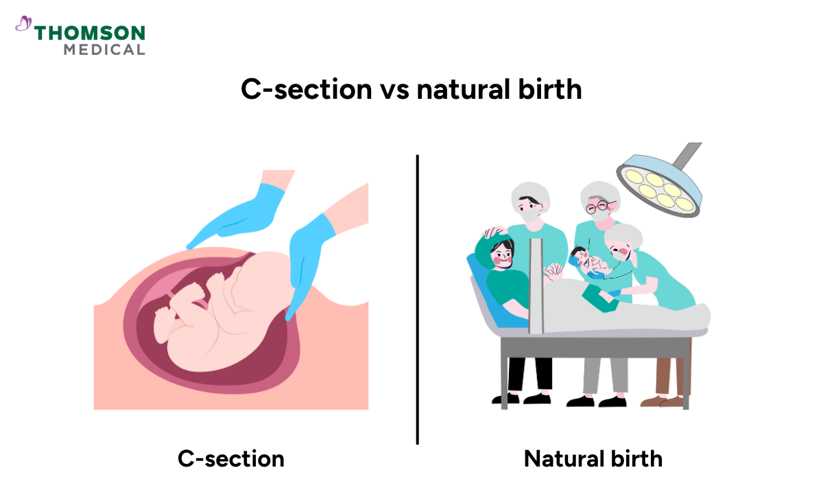 c-section vs natural birth