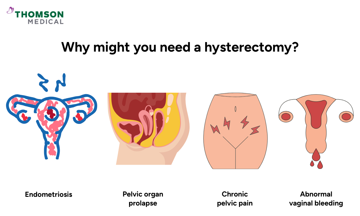 Illustration of why you might need a hysterectomy