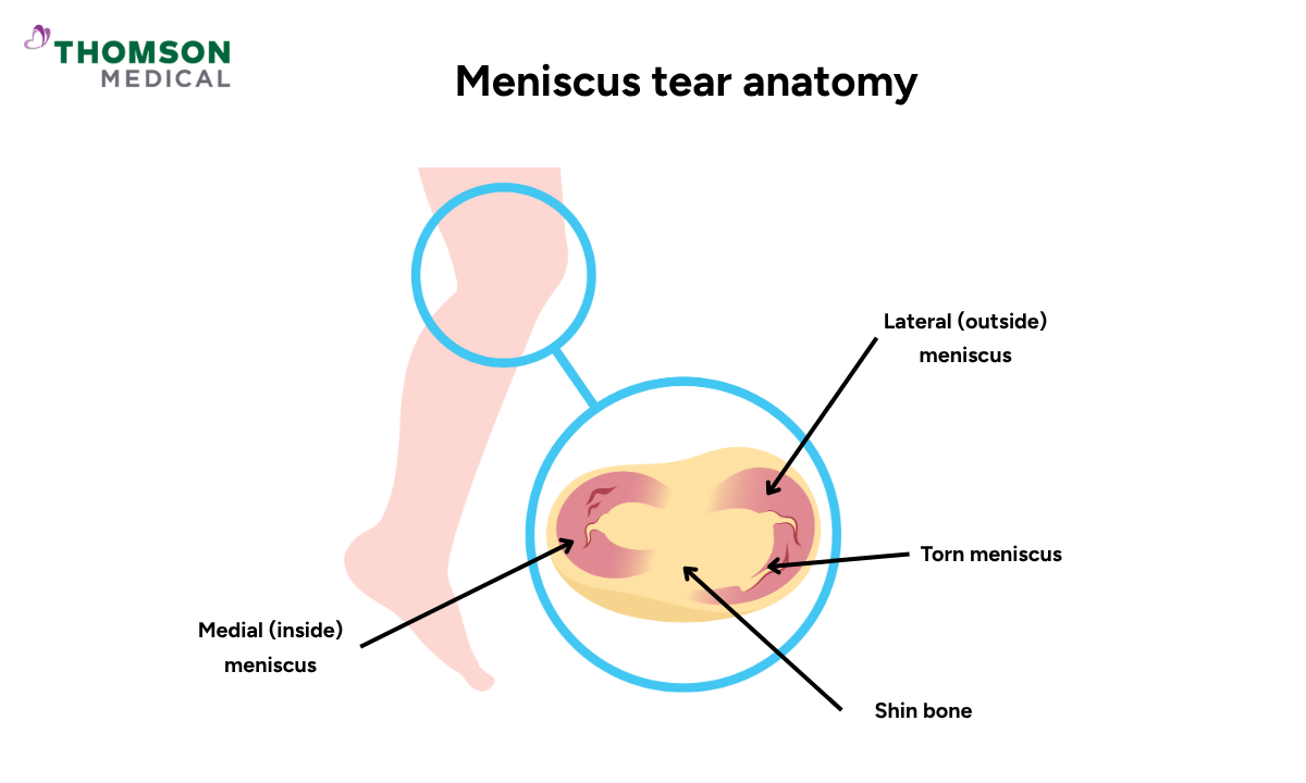 blog-image_orthopaedic_meniscus-tear-illustration.png