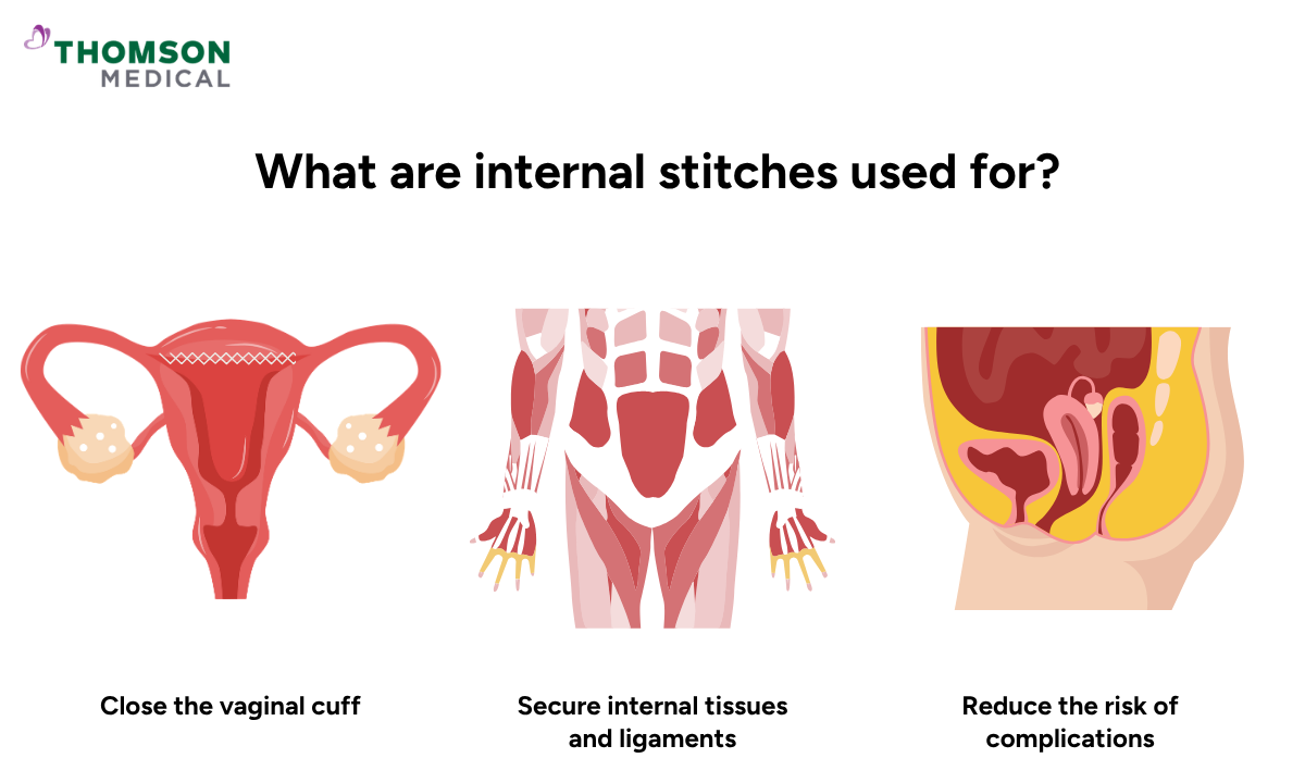 Illustration of what internal stitches are used for