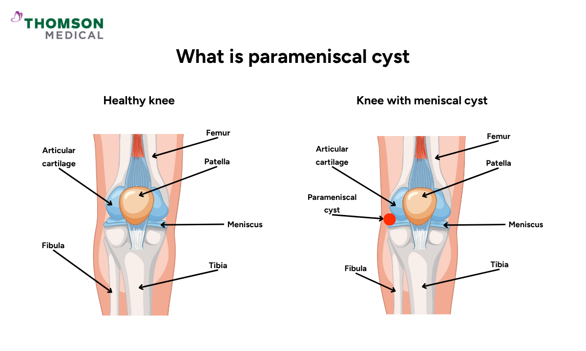 blog-image_screening_what-is-parameniscal-cyst.png