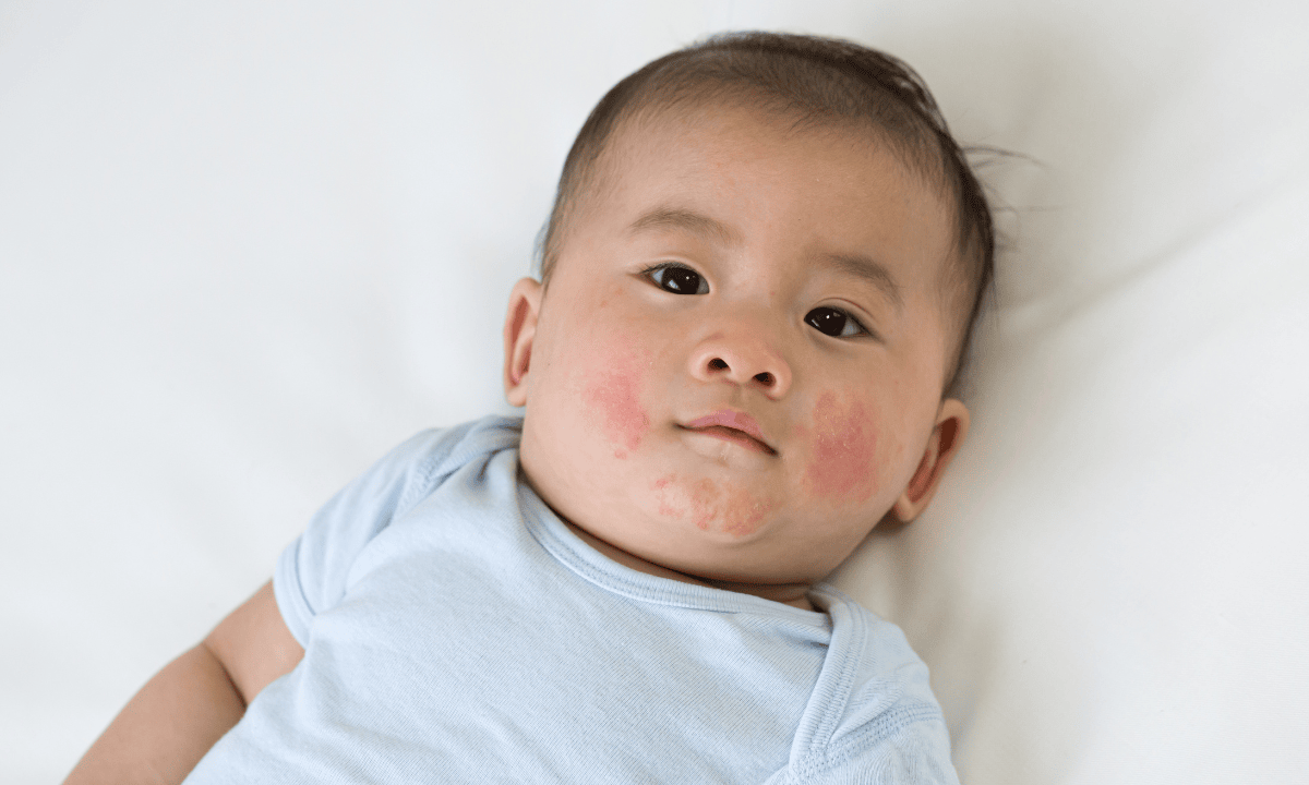 baby with eczema symptoms