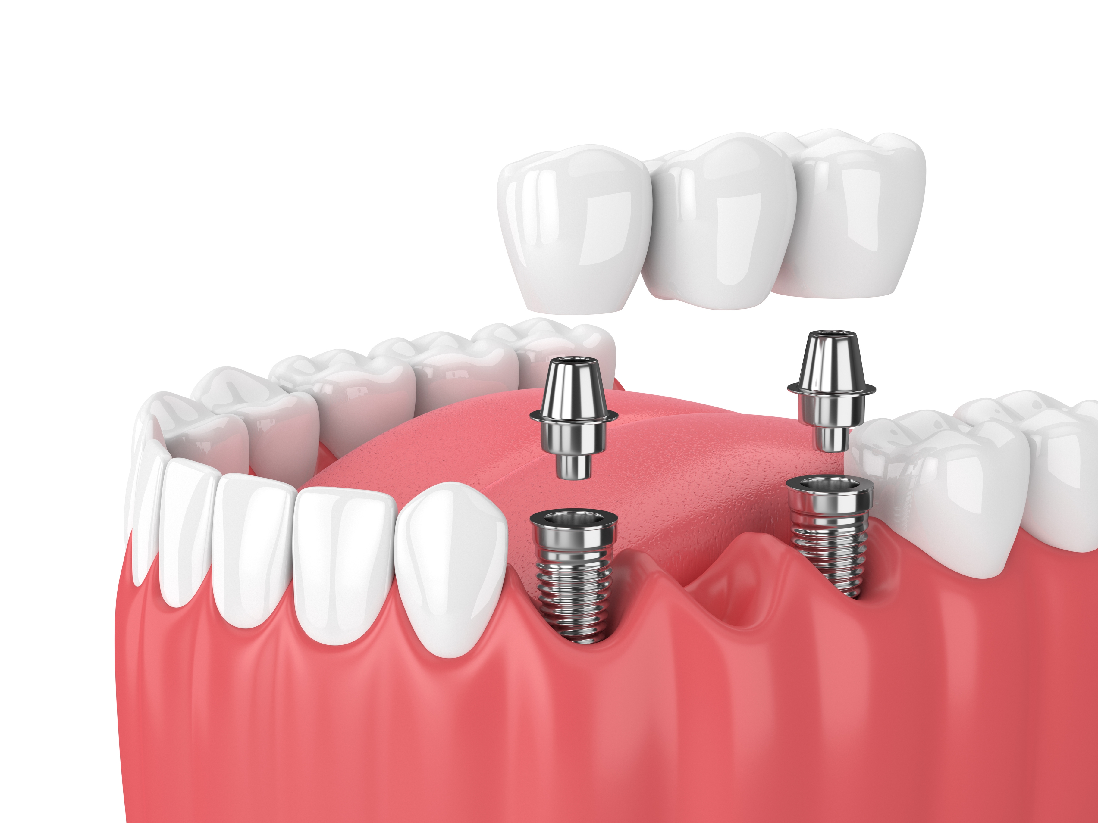 implant-dental-bridge.jpg