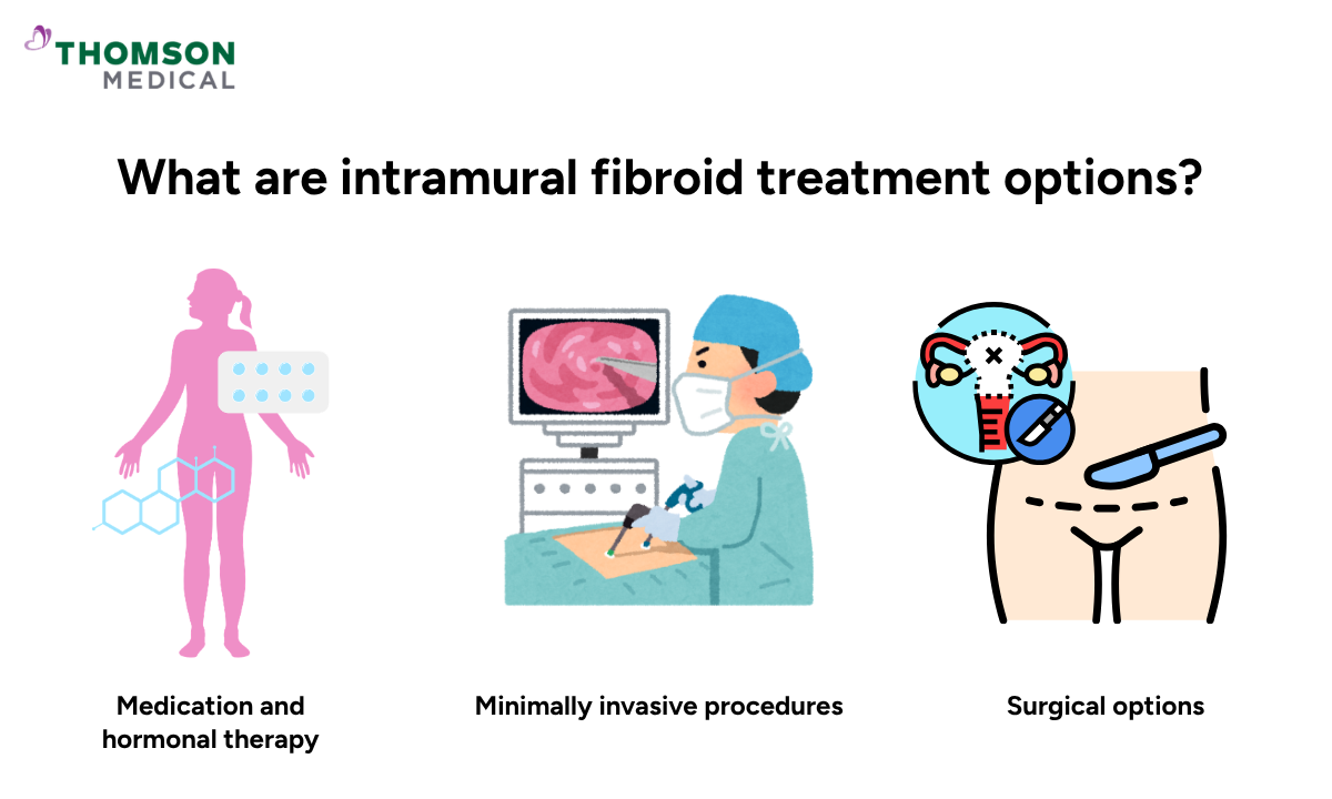 Illustration shows the treatment options for intramural fibroid