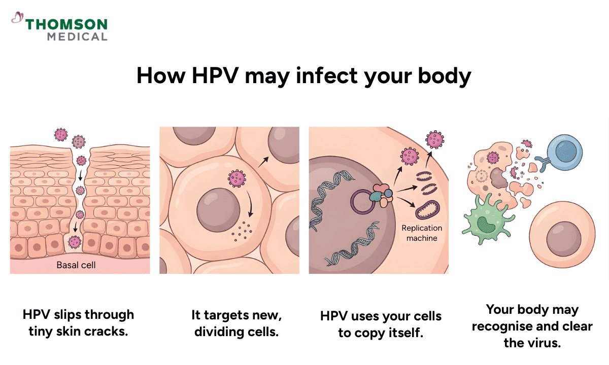 A four-step medical infographic showing how HPV enters through skin cracks, targets dividing cells, replicates, and is either cleared by the immune system or persists.