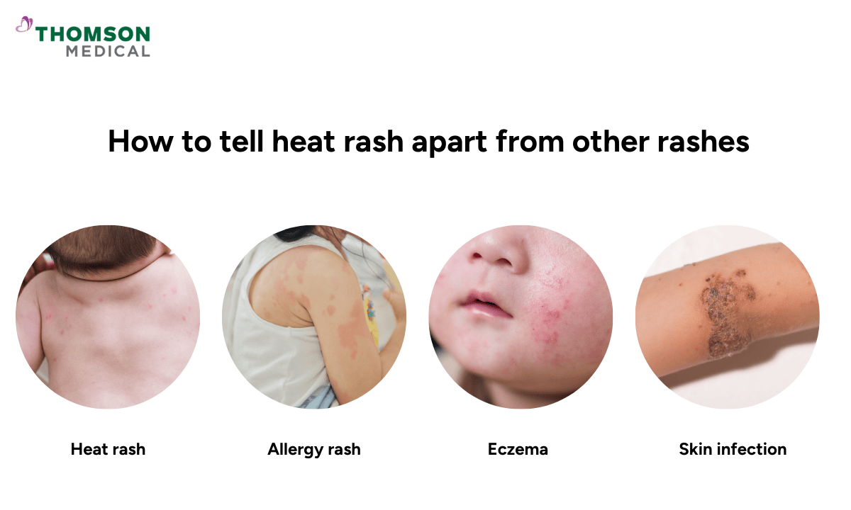 image of different types of baby rashes