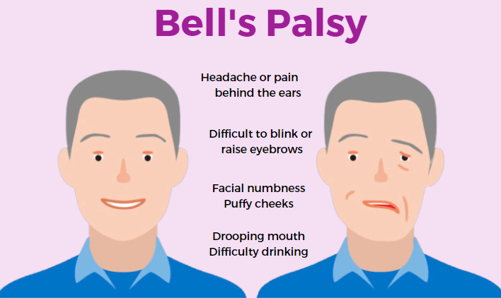 TCM Bells-Palsy 1.png