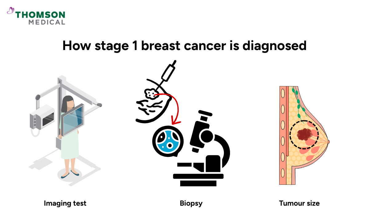 Illustration of how stage 1 breast cancer is diagnosed