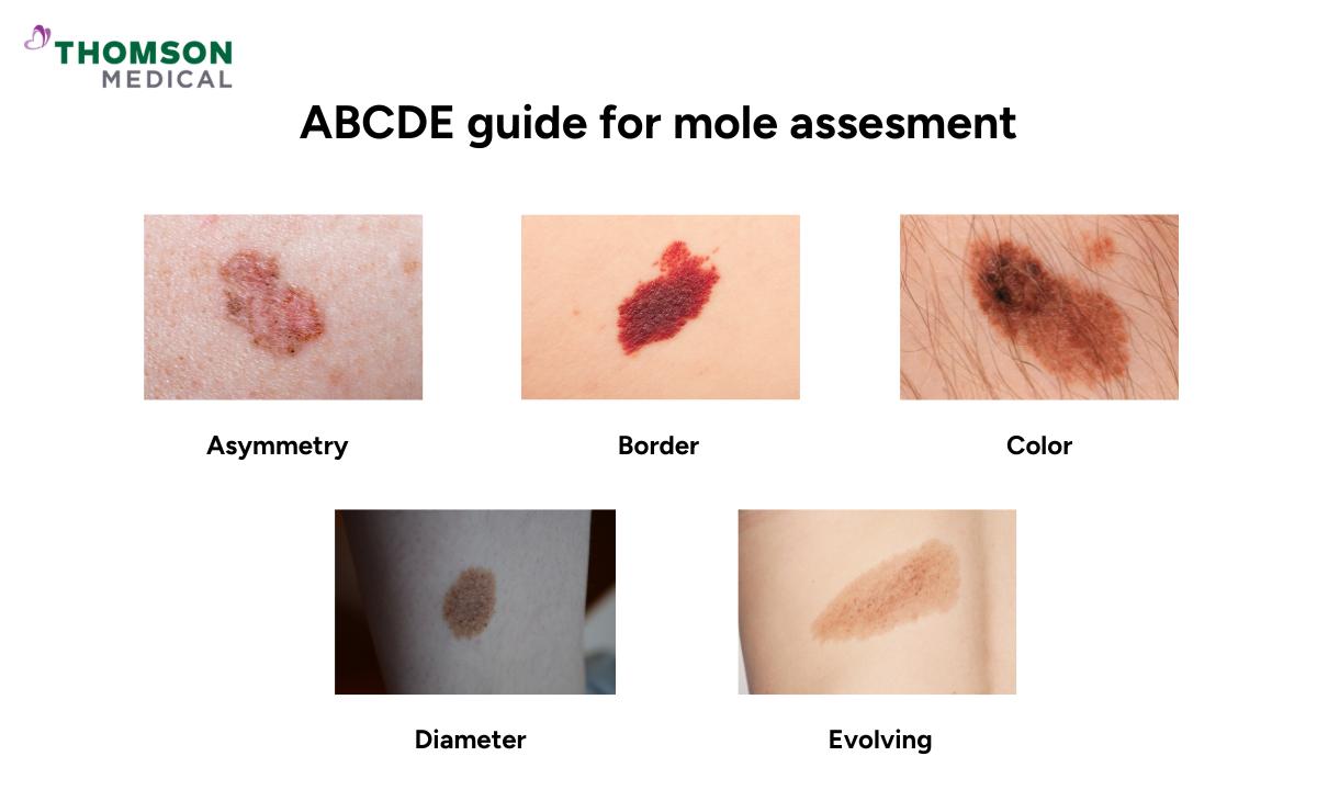 ABCDE guide for mole check