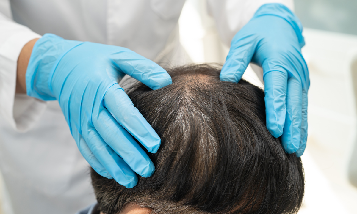 A dermatologist wearing blue gloves examines a patient's scalp, checking for lumps or irregularities like pilar cysts