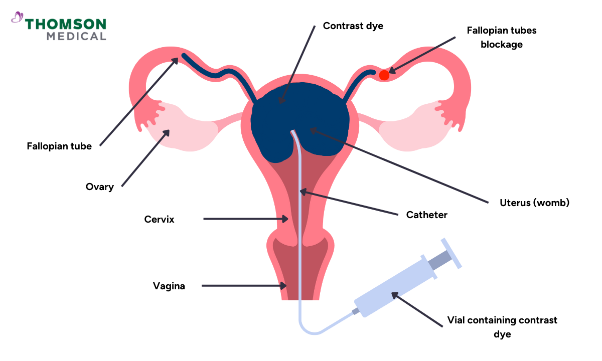 Illustration of hsg test procedure