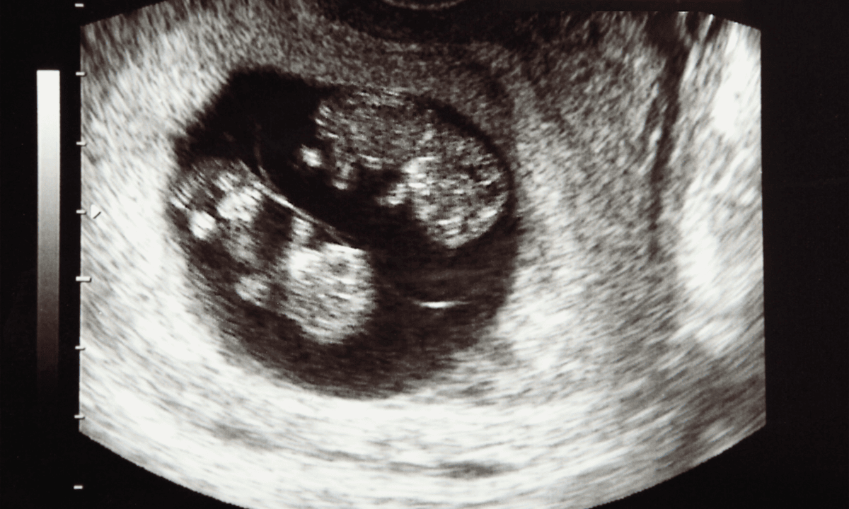 Identical twin baby scan