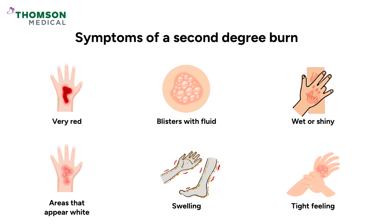 blog-image_ucc_symptoms-of-a-second-degree-burn.png