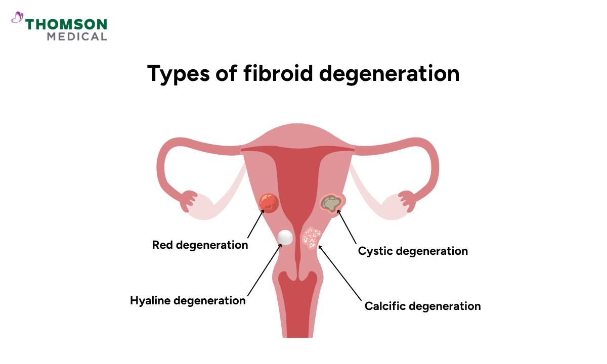 Illustration shows the types of fibroid degeneration
