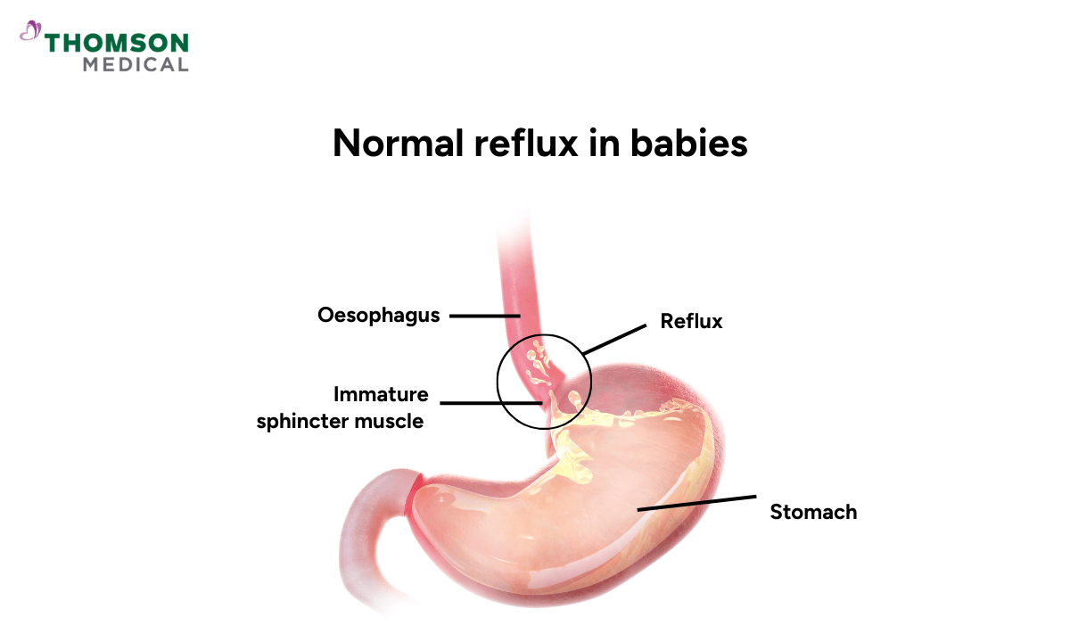 image of normal reflux in babies