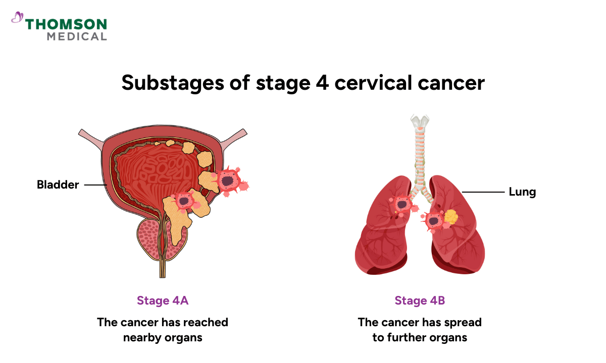 Substages of stage 4 cervical cancer