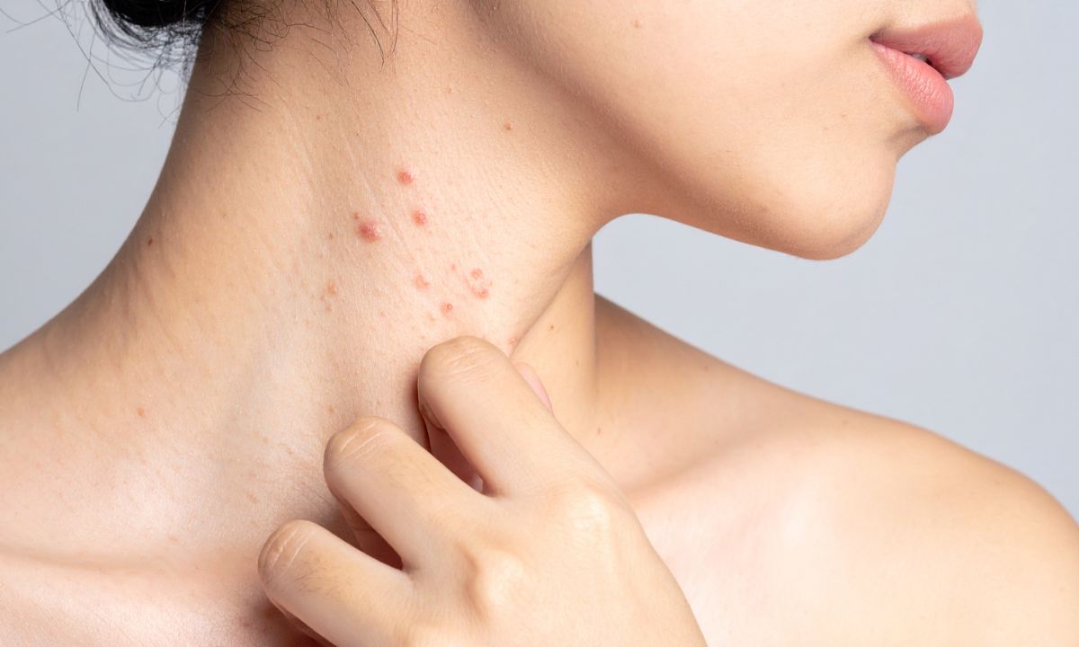 woman experiencing shingles in her neck