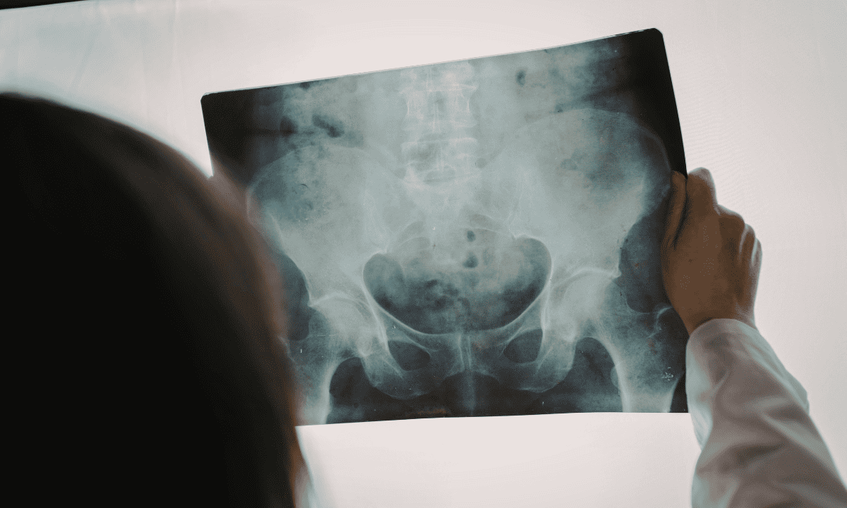 A person in a white lab coat holding up and examining an X-ray film of a human pelvis against a light source.