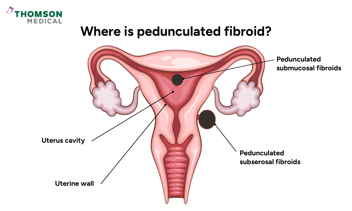 Illustration shows the pedunculated fibroids location