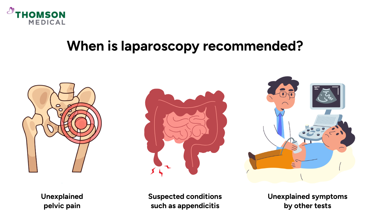 Illustration showing when a laparoscopic procedure is recommended